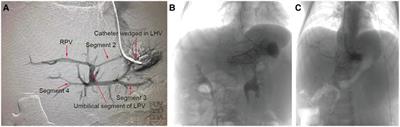 Is re-Rex shunt a better choice for patients with failed Rex shunt?